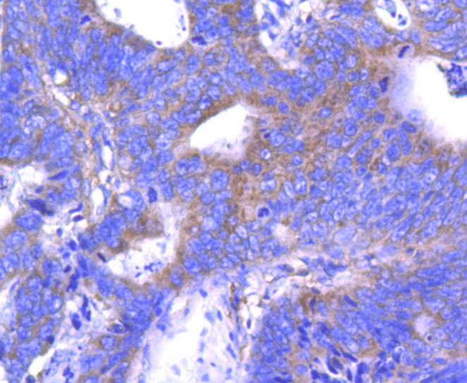 Fig6: Immunohistochemical analysis of paraffin-embedded human colon cancer tissue using anti-ABCF1 antibody. Counter stained with hematoxylin.