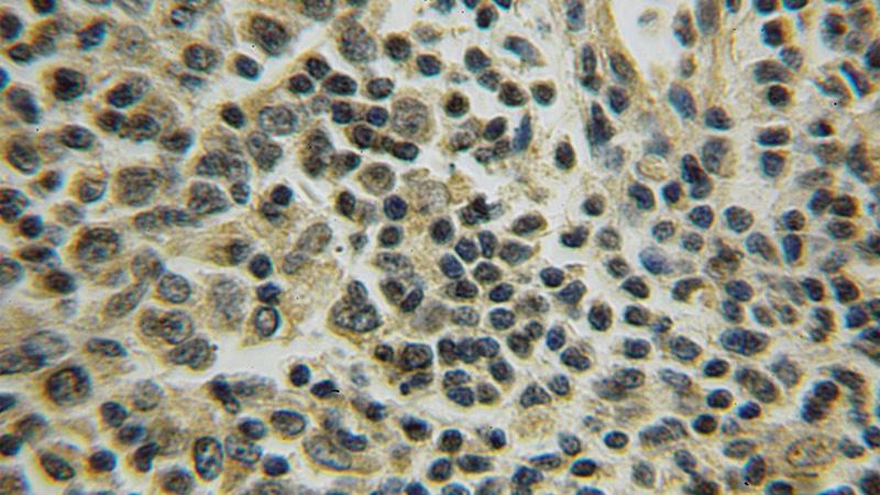 Immunohistochemical of paraffin-embedded human lymphoma using Catalog No:116553(UGCG antibody) at dilution of 1:100 (under 40x lens)