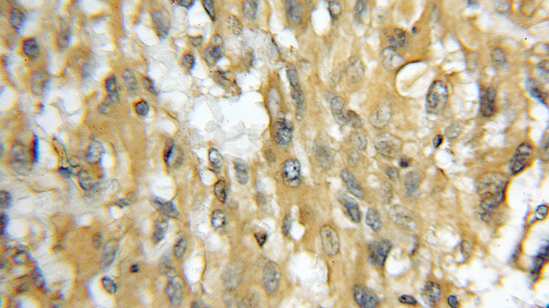 Immunohistochemical of paraffin-embedded human gliomas using Catalog No:116272(TMOD4 antibody) at dilution of 1:50 (under 10x lens)