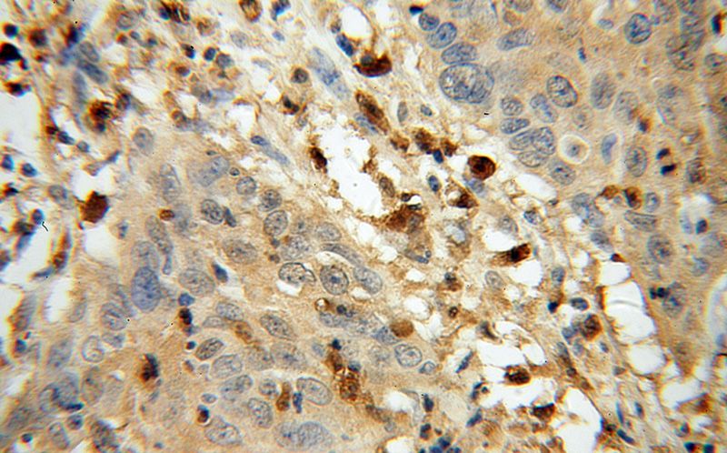 Immunohistochemical of paraffin-embedded human cervical cancer using Catalog No:110868(GART antibody) at dilution of 1:100 (under 40x lens)