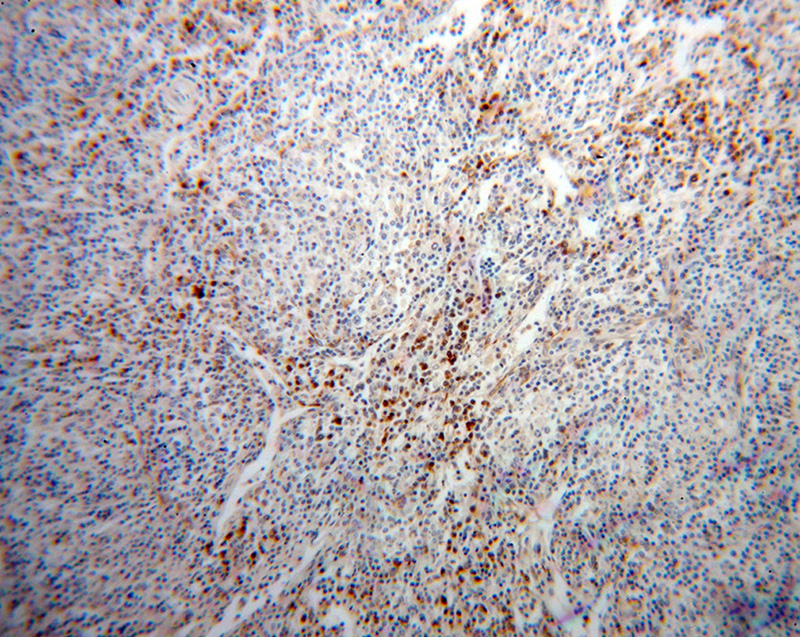 Immunohistochemical of paraffin-embedded human lymphoma using Catalog No:113816(PHGDH antibody) at dilution of 1:100 (under 10x lens)