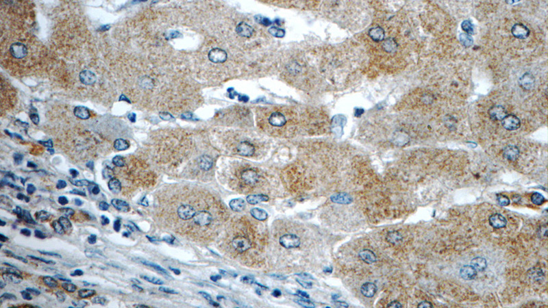 Immunohistochemistry of paraffin-embedded human hepatocirrhosis tissue slide using Catalog No:112732(RAGE Antibody) at dilution of 1:50 (under 40x lens)