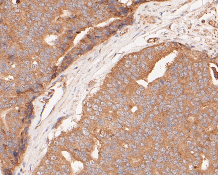 Fig5: Immunohistochemical analysis of paraffin-embedded human prostate carcinoma tissue using anti-Gasdermin D antibody. The section was pre-treated using heat mediated antigen retrieval with sodium citrate buffer (pH 6.0) for 20 minutes. The tissues were blocked in 5% BSA for 30 minutes at room temperature, washed with ddH2O and PBS, and then probed with the primary antibody ( 1/50) for 30 minutes at room temperature. The detection was performed using an HRP conjugated compact polymer system. DAB was used as the chromogen. Tissues were counterstained with hematoxylin and mounted with DPX.