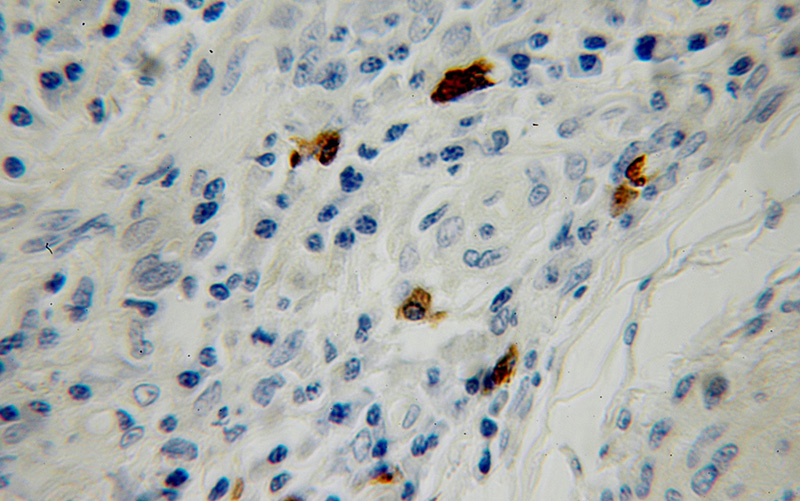 Immunohistochemical of paraffin-embedded human cervical cancer using Catalog No:115389(SMG5 antibody) at dilution of 1:100 (under 10x lens)