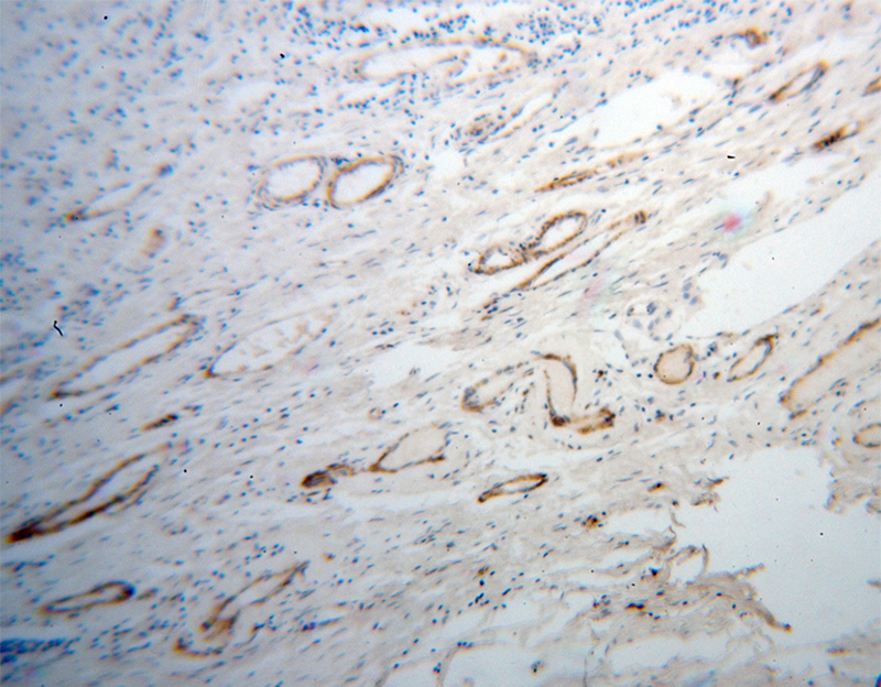 Immunohistochemical of paraffin-embedded human ovary tumor using Catalog No:116651(UBL4A antibody) at dilution of 1:100 (under 10x lens)