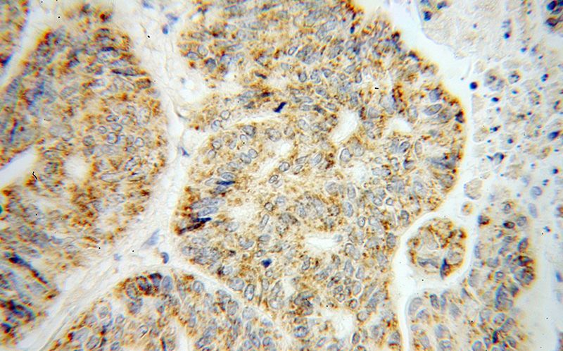 Immunohistochemical of paraffin-embedded human liver cancer using Catalog No:117107(BCO2 antibody) at dilution of 1:50 (under 40x lens)