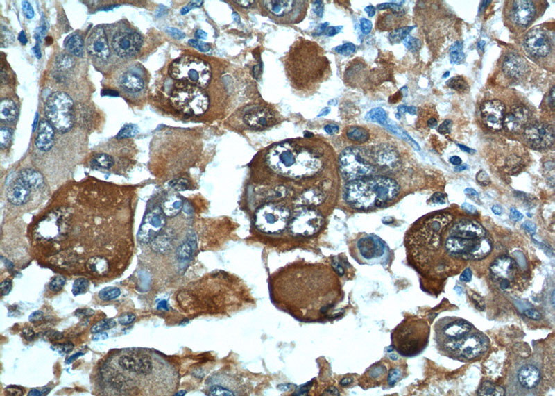 Immunohistochemistry of paraffin-embedded human liver cancer tissue slide using Catalog No:114963(S100A6 Antibody) at dilution of 1:200 (under 40x lens).