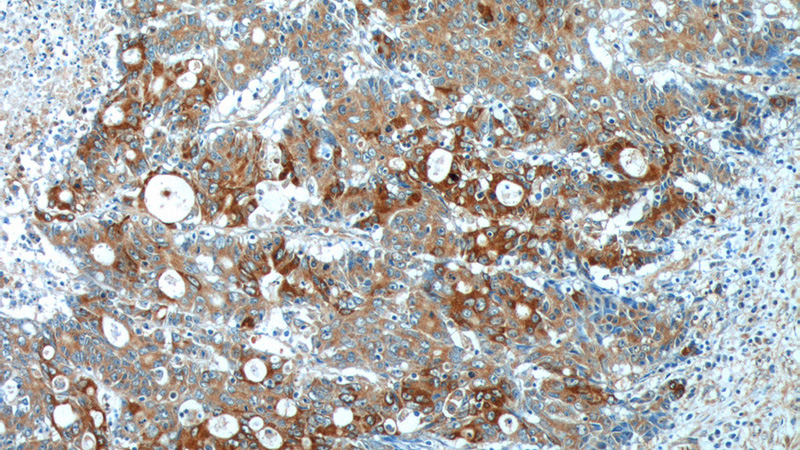 Immunohistochemistry of paraffin-embedded human colon cancer tissue slide using Catalog No:111762(IL17A Antibody) at dilution of 1:200 (under 10x lens).