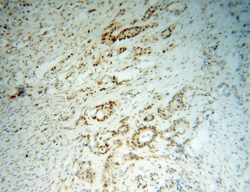 Immunohistochemical of paraffin-embedded human colon cancer using Catalog No:112867(MSH2 antibody) at dilution of 1:100 (under 10x lens)