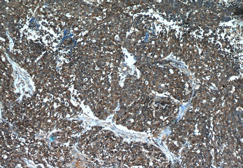 Immunohistochemical of paraffin-embedded human lung cancer using Catalog No:107324(NCAM1 antibody) at dilution of 1:50 (under 10x lens)