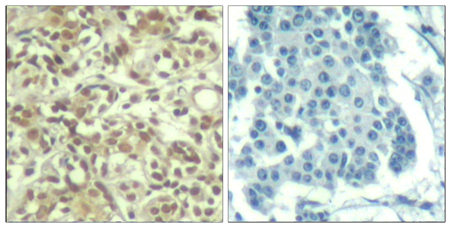 Immunohistochemical analysis of paraffin-embedded human breast carcinoma tissue using AKT1 (Phospho-Thr450) Antibody (left) or the same antibody preincubated with blocking peptide (right).