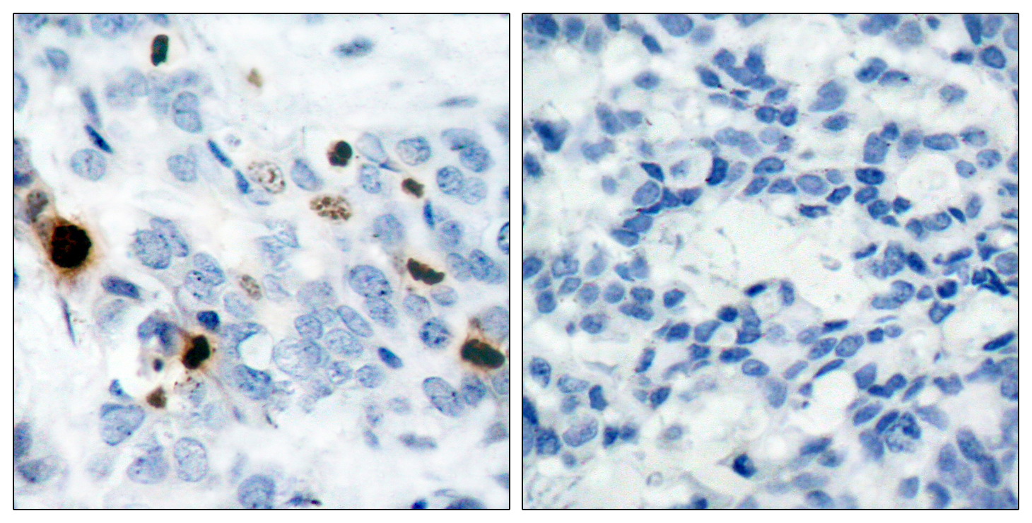 Immunohistochemical analysis of paraffin-embedded human breast carcinoma tissue using Histone H3.1 (Phospho-Ser10) Antibody (left) or the same antibody preincubated with blocking peptide #51184 (right).