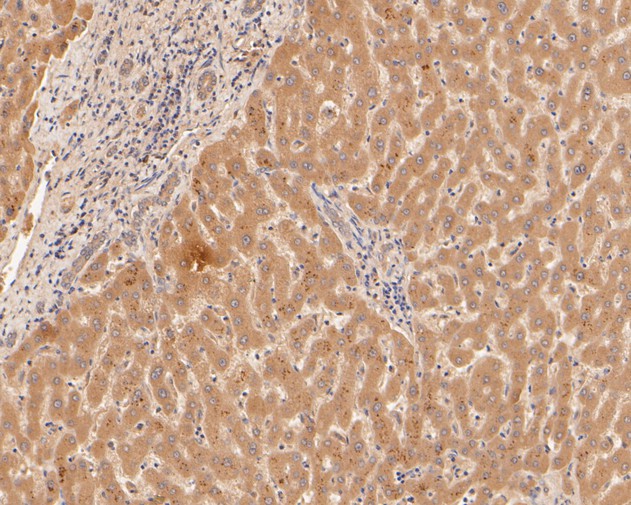 Fig1:; Immunohistochemical analysis of paraffin-embedded human liver tissue using anti-Alpha-2-macroglobulin antibody. The section was pre-treated using heat mediated antigen retrieval with Tris-EDTA buffer (pH 8.0-8.4) for 20 minutes.The tissues were blocked in 5% BSA for 30 minutes at room temperature, washed with ddH; 2; O and PBS, and then probed with the primary antibody ( 1/100) for 30 minutes at room temperature. The detection was performed using an HRP conjugated compact polymer system. DAB was used as the chromogen. Tissues were counterstained with hematoxylin and mounted with DPX.
