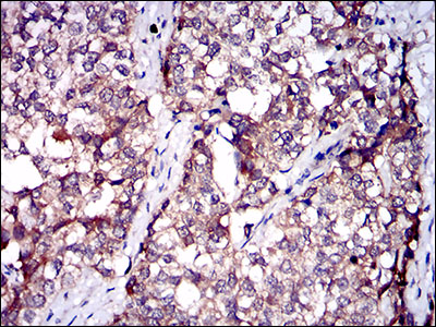 Fig5: Immunohistochemical analysis of paraffin-embedded human bladder cancer tissue using anti-SERPINA7 antibody. Counter stained with hematoxylin.