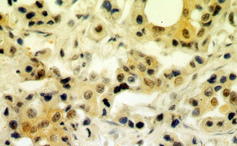 Immunohistochemical of paraffin-embedded human breast cancer using Catalog No:107075(B23 antibody) at dilution of 1:100 (under 40x lens)