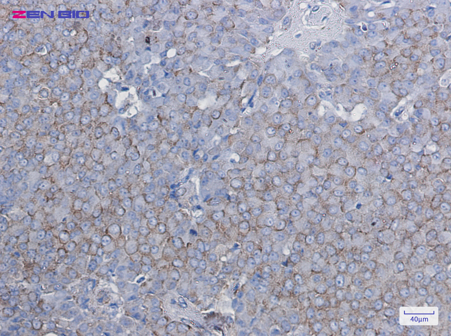 Immunohistochemistry of BTF3 in paraffin-embedded Human breast cancer tissue using BTF3 Rabbit pAb at dilution 1/50