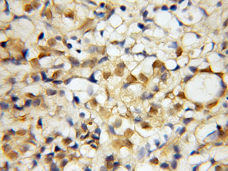 Immunohistochemical of paraffin-embedded human pancreas cancer using Catalog No:115059(SAP130 antibody) at dilution of 1:50 (under 10x lens)