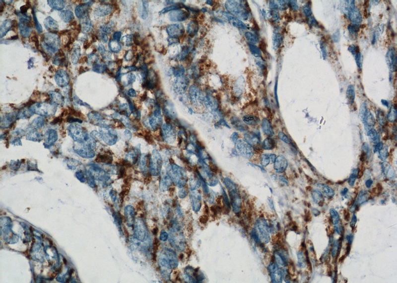 Immunohistochemical of paraffin-embedded human colon cancer using Catalog No:108393(B4GALT2 antibody) at dilution of 1:100 (under 40x lens)