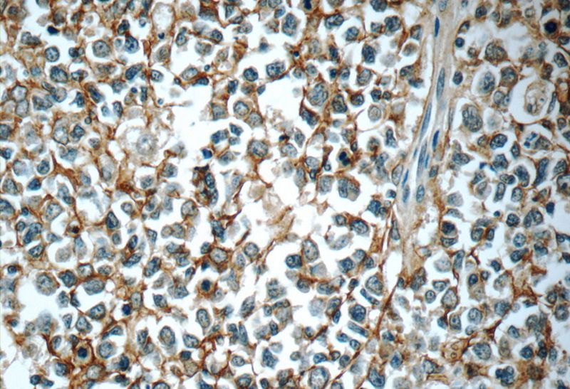 Immunohistochemistry of paraffin-embedded human tonsillitis tissue slide using Catalog No:109042(CD11B Antibody) at dilution of 1:50 (under 40x lens)