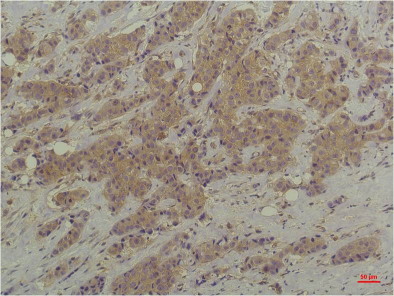 Immunohistochemical analysis of paraffin-embedded Human Breast Carcinoma usingP44/42 MAPK (ERK1/2)  Mouse mAb diluted at 1:200.