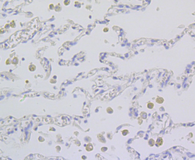 Fig4: Immunohistochemical analysis of paraffin-embedded human lung cancer tissue using anti-TESPA1 antibody. Counter stained with hematoxylin.