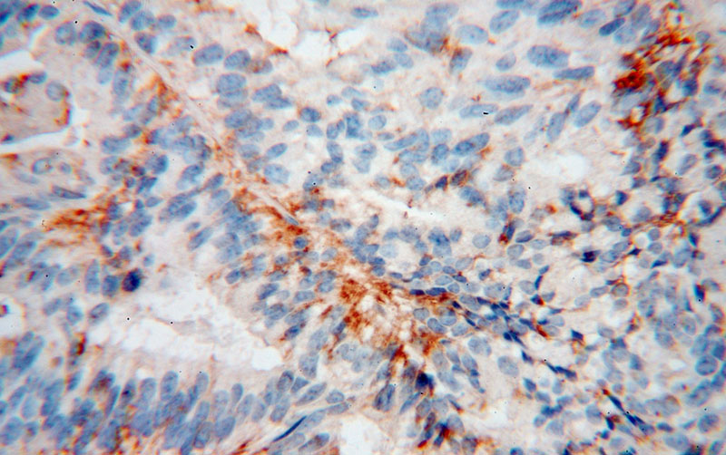 Immunohistochemical of paraffin-embedded human ovary tumor using Catalog No:110742(FST antibody) at dilution of 1:100 (under 40x lens)