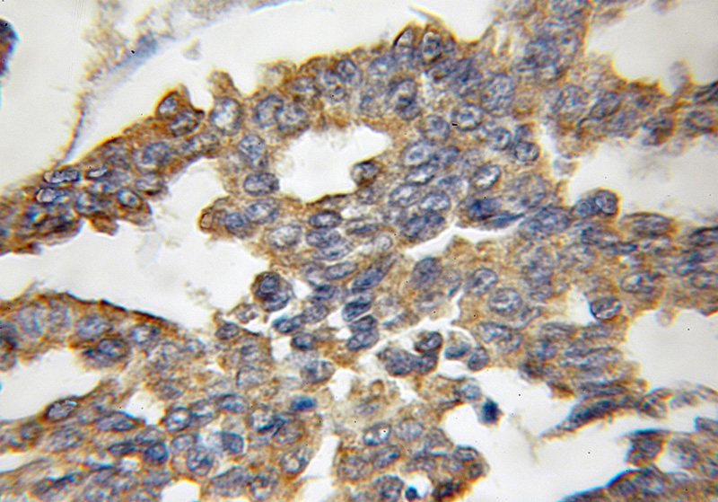 Immunohistochemical of paraffin-embedded human breast cancer using Catalog No:116457(TXNL6 antibody) at dilution of 1:100 (under 10x lens)