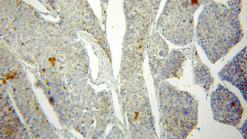 Immunohistochemical of paraffin-embedded human liver cancer using Catalog No:114426(RAB27A-specific antibody) at dilution of 1:50 (under 10x lens)