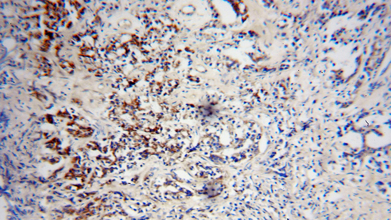 Immunohistochemical of paraffin-embedded human gliomas using Catalog No:113413(OPRL1 antibody) at dilution of 1:100 (under 10x lens)