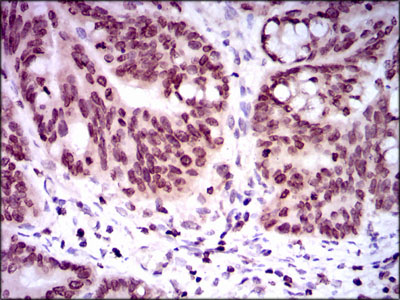 Immunohistochemical analysis of paraffin-embedded rectum cancer tissues using NR6A1 mouse mAb with DAB staining.