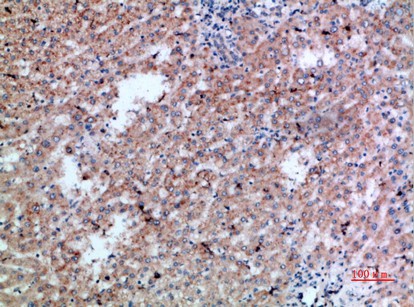 Fig1:; Immunohistochemical analysis of paraffin-embedded human-liver-cancer, antibody was diluted at 1:200