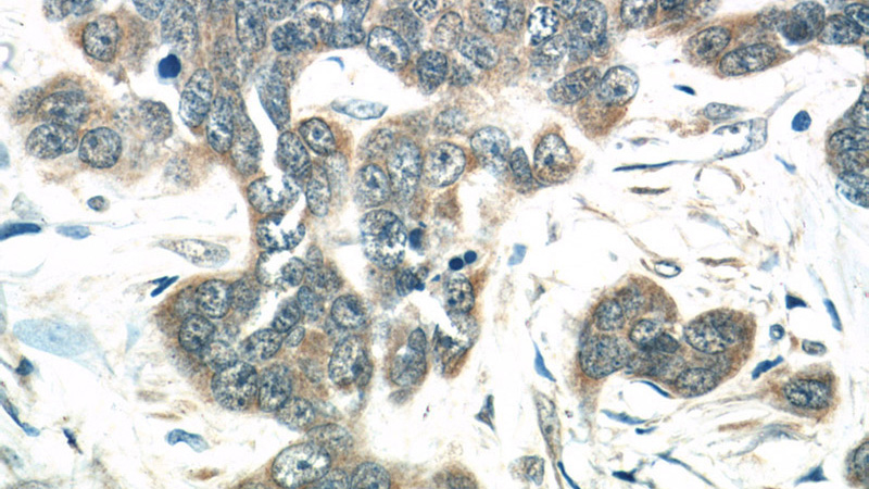 Immunohistochemistry of paraffin-embedded human skin cancer tissue slide using Catalog No:112605(MIA Antibody) at dilution of 1:50 (under 40x lens)