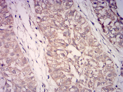 Fig3: Immunohistochemical analysis of paraffin-embedded bladder cancer tissues using anti-WDFY3 antibody. The section was pre-treated using heat mediated antigen retrieval with Tris-EDTA buffer (pH 8.0) for 20 minutes. The tissues were blocked in 5% BSA for 30 minutes at room temperature, washed with ddH2O and PBS, and then probed with the primary antibody ( 1/100) for 30 minutes at room temperature. The detection was performed using an HRP conjugated compact polymer system. DAB was used as the chromogen. Tissues were counterstained with hematoxylin and mounted with DPX.
