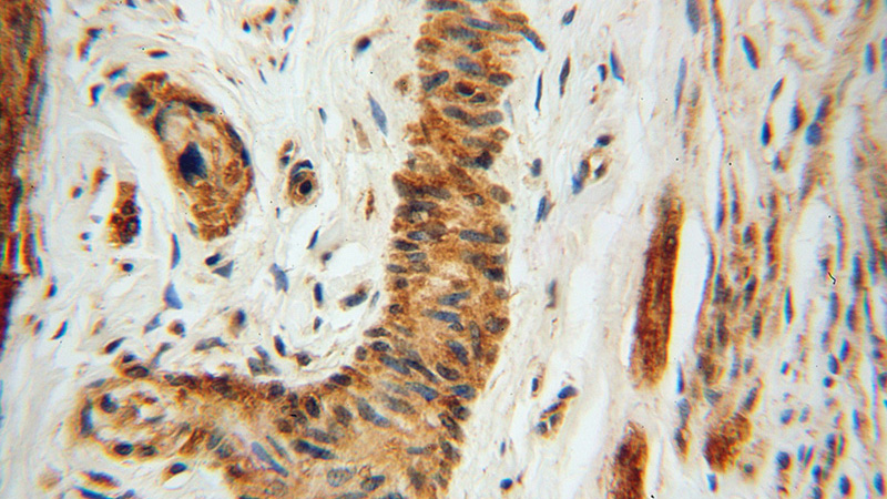 Immunohistochemical of paraffin-embedded human cervical cancer using Catalog No:111842(IRF9 antibody) at dilution of 1:50 (under 40x lens)