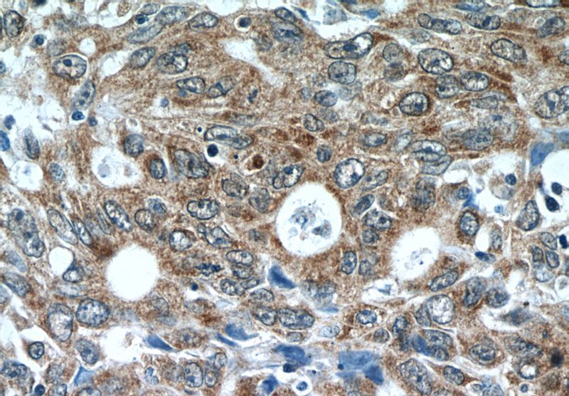 Immunohistochemistry of paraffin-embedded human colon cancer tissue slide using Catalog No:107927(AKAP1 Antibody) at dilution of 1:50 (under 40x lens)