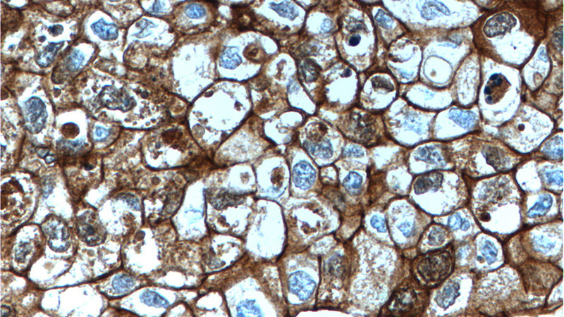 Immunohistochemistry of paraffin-embedded human breast cancer tissue slide using Catalog No:107244(E-cadherin Antibody) at dilution of 1:300 (under 40x lens). Heat mediated antigen retrieved with Tris-EDTA buffer(pH9).