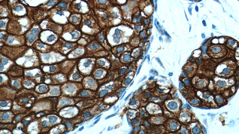 Immunohistochemistry of paraffin-embedded human breast cancer tissue slide using Catalog No:107260(ERBB2 Antibody) at dilution of 1:200 (under 40x lens)