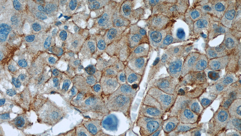 Immunohistochemical of paraffin-embedded human liver cancer using Catalog No:114791(RP2 antibody) at dilution of 1:50 (under 40x lens)