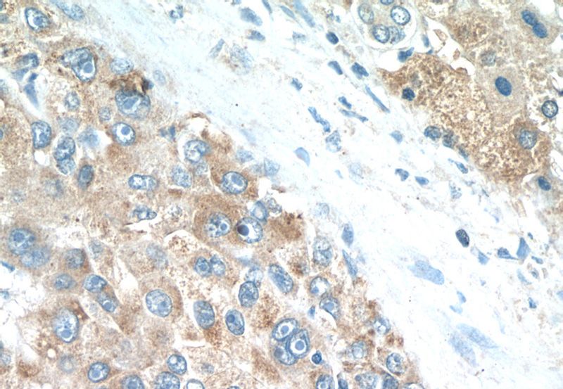Immunohistochemistry of paraffin-embedded human liver cancer tissue slide using Catalog No:113677(PDGFRL Antibody) at dilution of 1:50 (under 40x lens)
