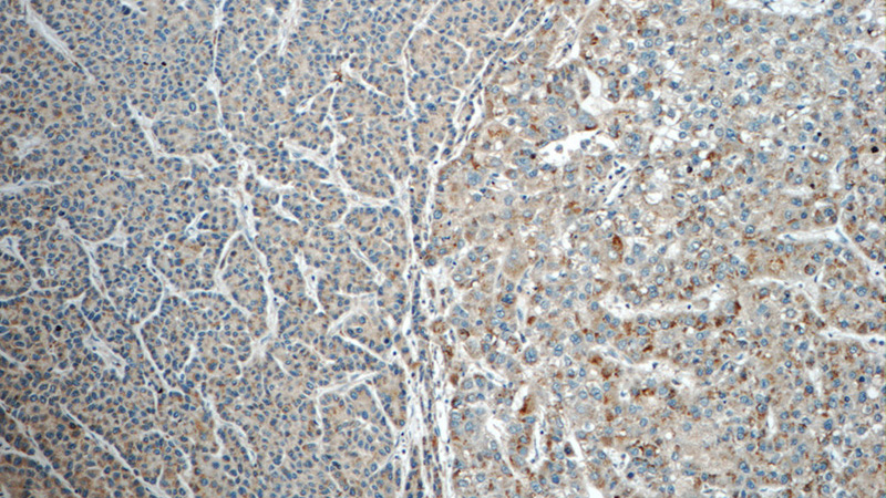 Immunohistochemistry of paraffin-embedded human liver cancer tissue slide using Catalog No:112280(LMF1 Antibody) at dilution of 1:50 (under 10x lens)