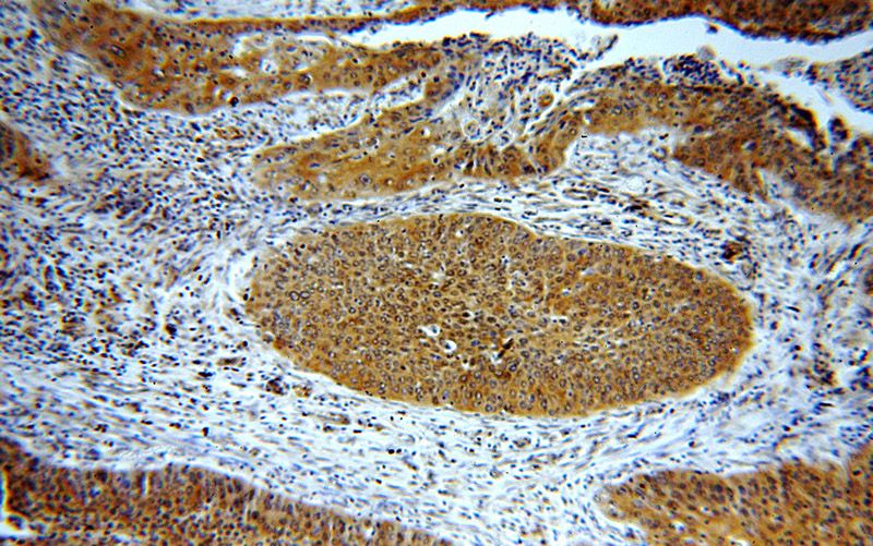 Immunohistochemical of paraffin-embedded human cervical cancer using Catalog No:108540(BTF3L3-Specific antibody) at dilution of 1:50 (under 10x lens)