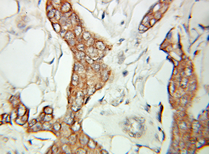 Immunohistochemical of paraffin-embedded human breast cancer using Catalog No:115000(SCLY antibody) at dilution of 1:100 (under 10x lens)