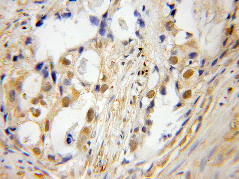 Immunohistochemical of paraffin-embedded human lung cancer using Catalog No:116308(TRIM27 antibody) at dilution of 1:100 (under 10x lens)