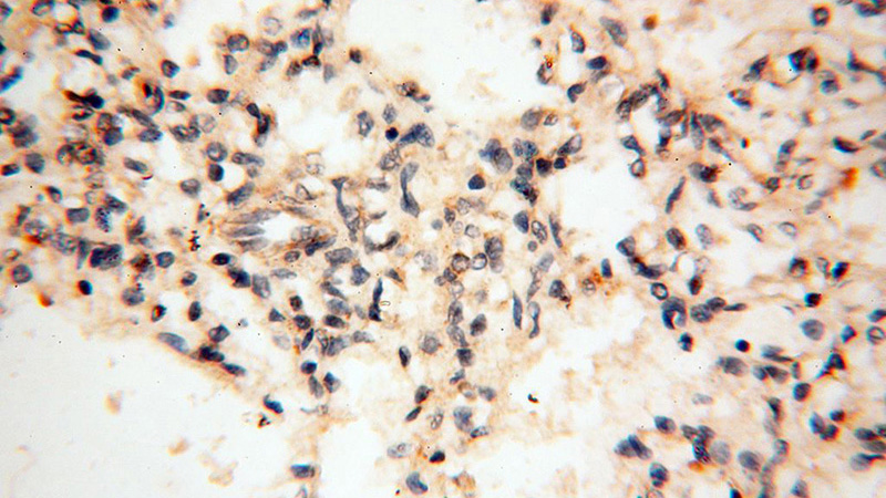 Immunohistochemical of paraffin-embedded human lung using Catalog No:111095(CSF2 antibody) at dilution of 1:100 (under 40x lens)