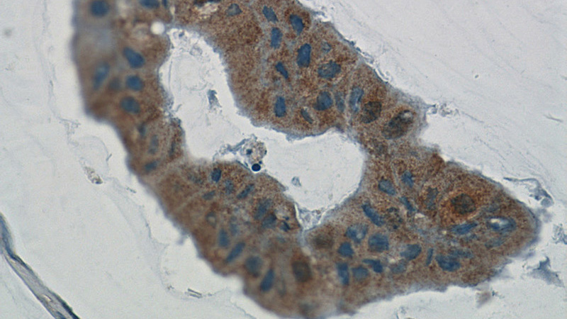 Immunohistochemistry of paraffin-embedded human breast cancer tissue slide using Catalog No:109632(CWF19L2 Antibody) at dilution of 1:50 (under 40x lens)