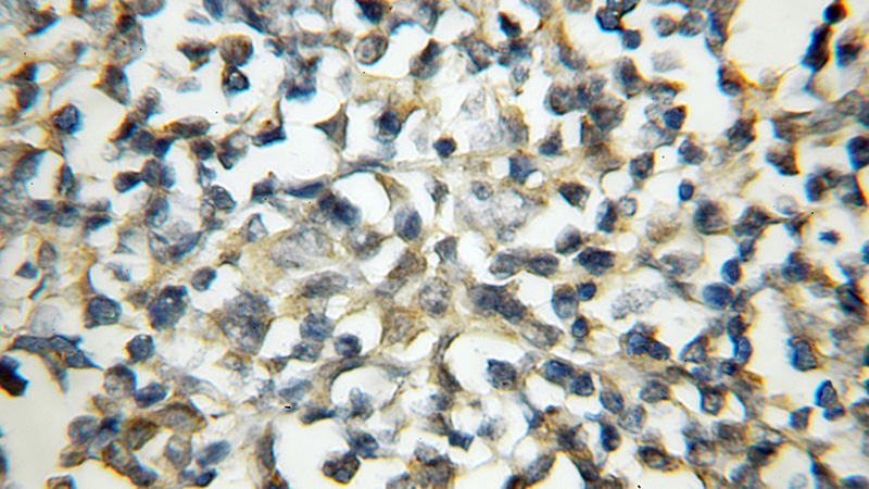 Immunohistochemical of paraffin-embedded human lymphoma using Catalog No:112459(MALT1 antibody) at dilution of 1:50 (under 10x lens)