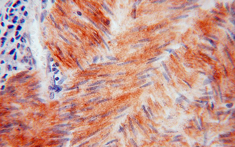 Immunohistochemical of paraffin-embedded human colon cancer using Catalog No:111701(HSPB7 antibody) at dilution of 1:50 (under 40x lens)