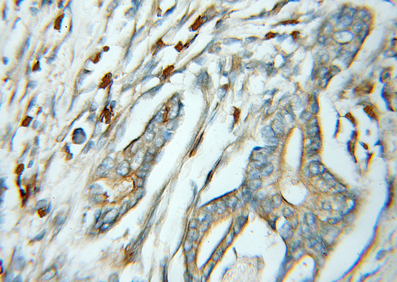 Immunohistochemical of paraffin-embedded human pancreas cancer using Catalog No:115609(SSR4 antibody) at dilution of 1:50 (under 10x lens)