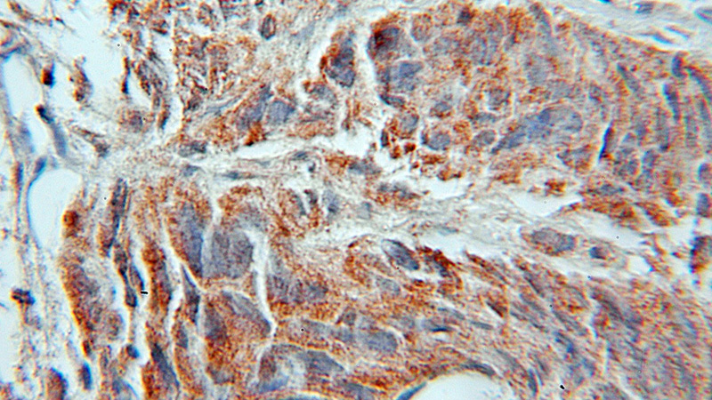 Immunohistochemical of paraffin-embedded human prostate cancer using Catalog No:107989(AMD1 antibody) at dilution of 1:50 (under 10x lens)