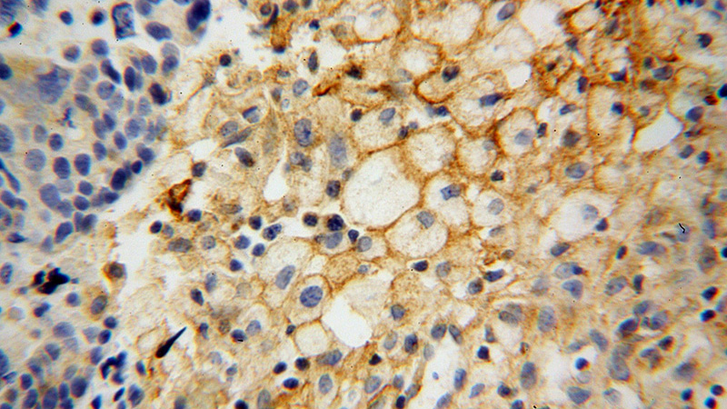 Immunohistochemical of paraffin-embedded human ovary tumor using Catalog No:111546(HSD17B2 antibody) at dilution of 1:100 (under 40x lens)